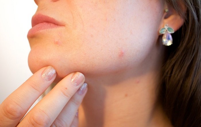 Different Foods That Can Help With Acne foods that help with acne
