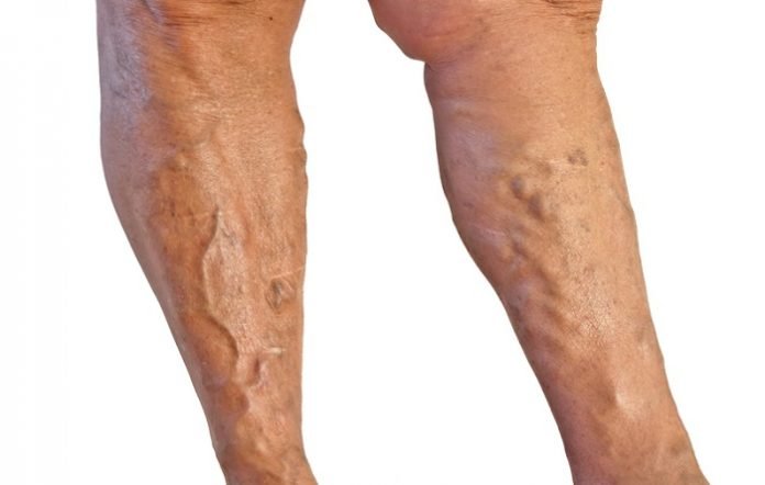 Dietary Tips for Treating Varicose Veins Faster Dietary Tips for Treating Varicose Veins Faster