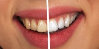 Best Teeth Whitening Kit GLO Science Vs. SNOW