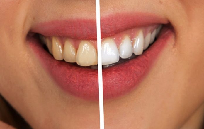 Best Teeth Whitening Kit GLO Science Vs. SNOW Best Teeth Whitening Kit GLO Science Vs. SNOW