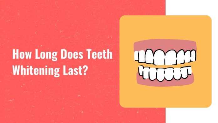 how-long-does-teeth-whitening-last How long does teeth whitening last